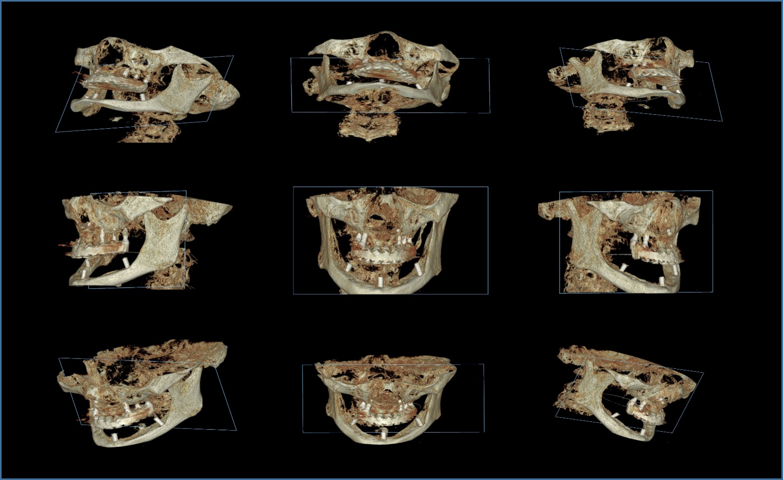 3D CT 9방향 진단 영상